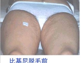 比基尼脱毛前.jpg
